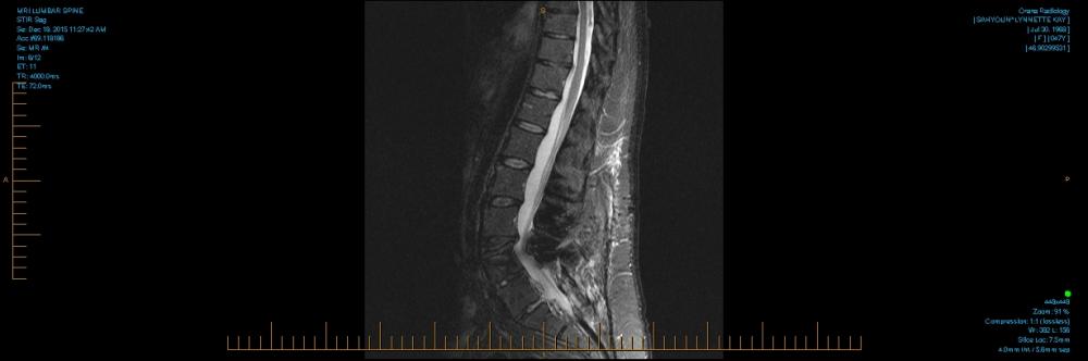 MRI LUMBAR SPINE 0004.jpg
