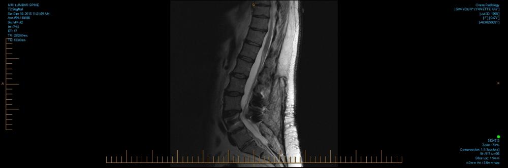 MRI LUMBAR SPINE 0001.jpg
